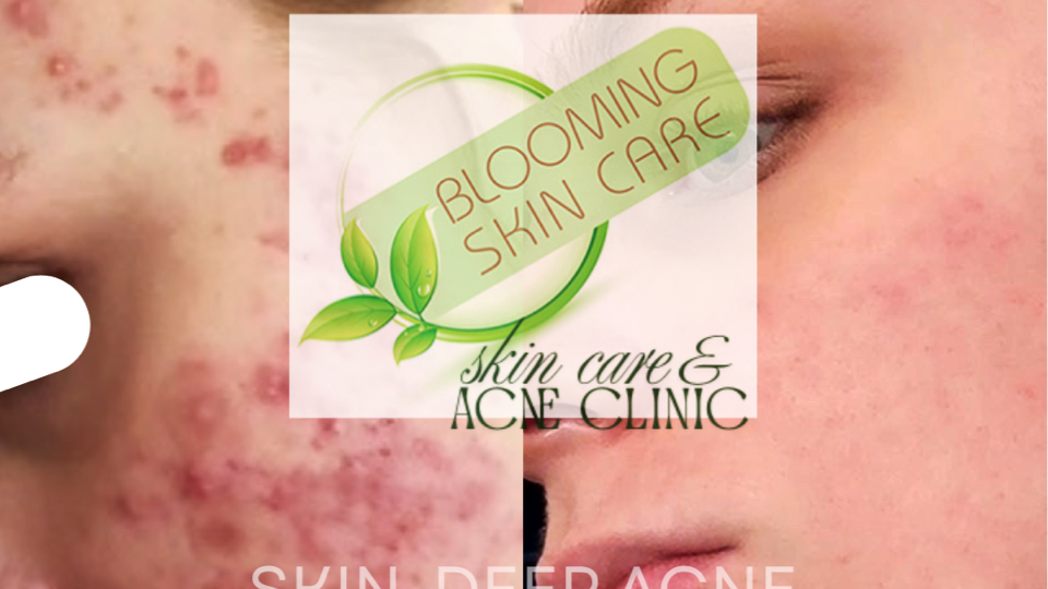 Blooming Skin Care & Acne Clinic - Beauty Spa in Bloomington